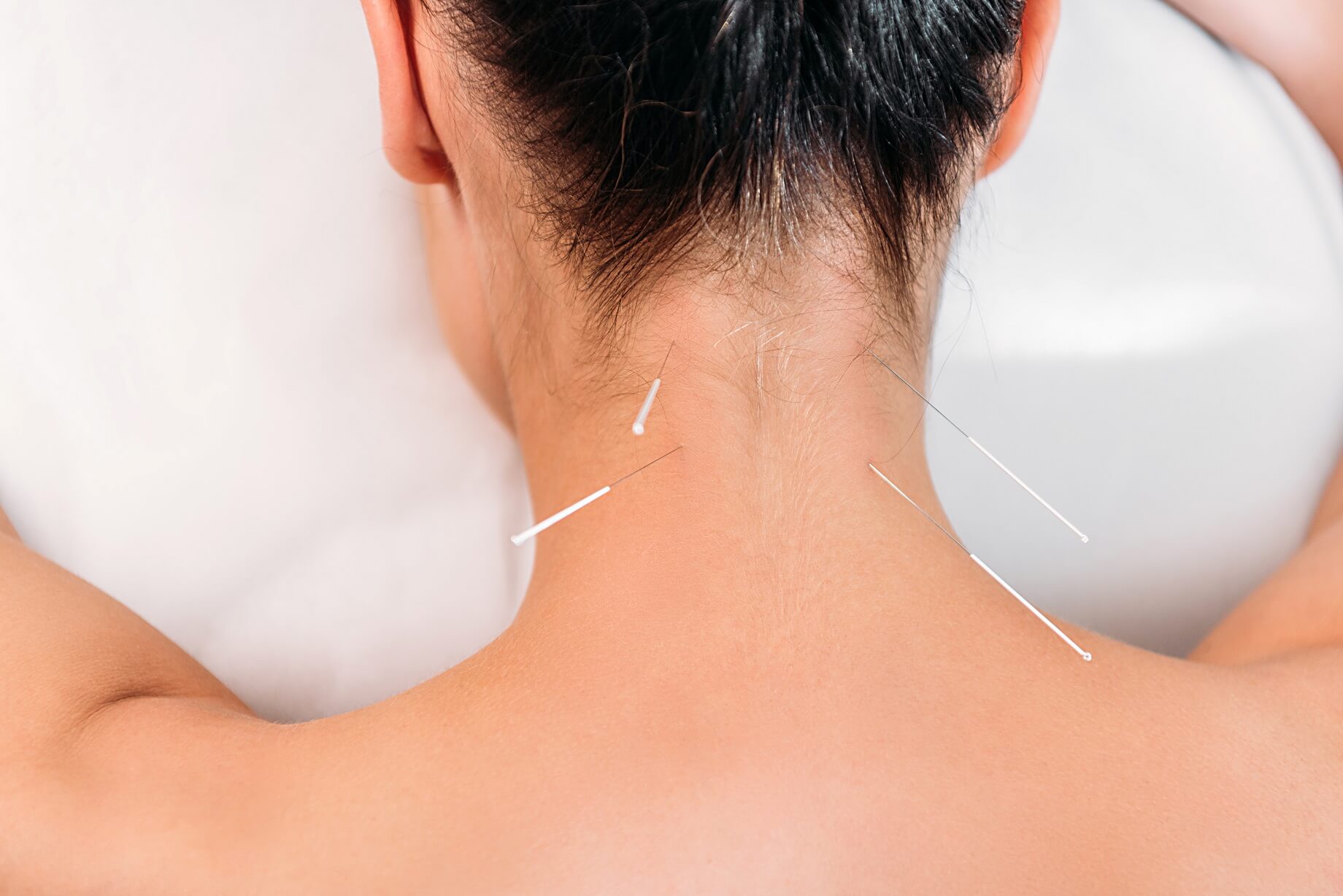 5 Reasons You Might Need an Acupuncture in Mississauga Right Now